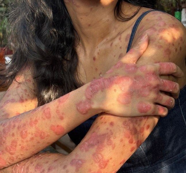 Psoriasis plaques across a woman’s arms and chest