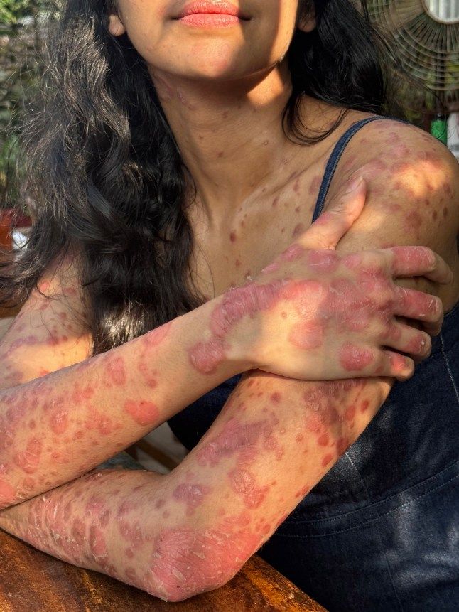 Psoriasis plaques across a woman’s arms and chest