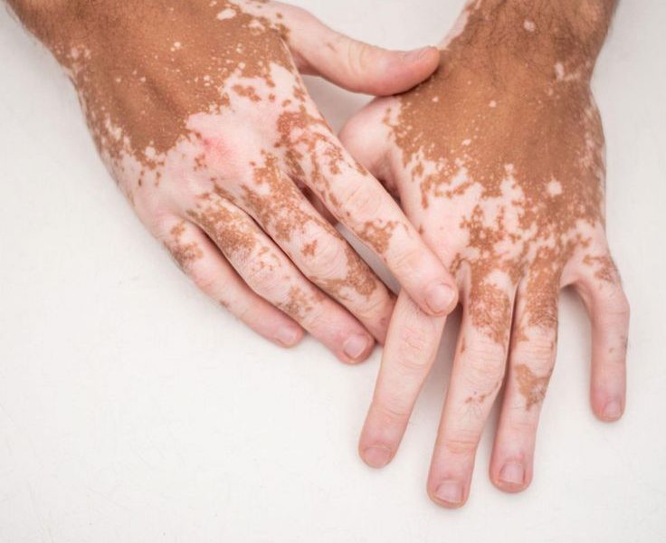 Vitiligo depigmentation across the backs of both hands