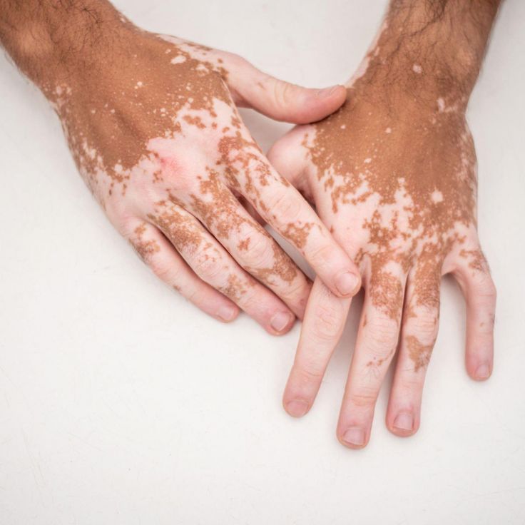 Vitiligo depigmentation across the backs of both hands