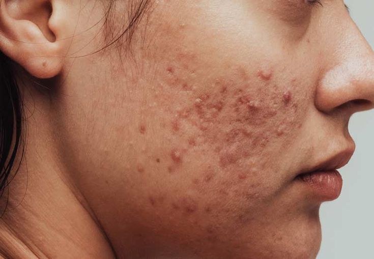 Close-up of acne across a young woman’s cheek and jawline