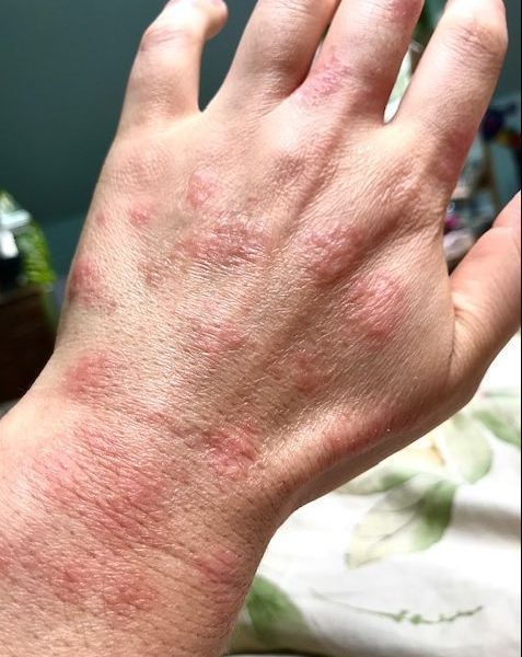 Inflamed, patchy dermatitis across the back of a hand