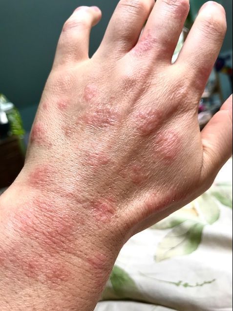 Inflamed, patchy dermatitis across the back of a hand