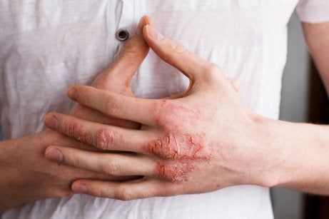 Cracked, inflamed eczema across the back of a man’s hand