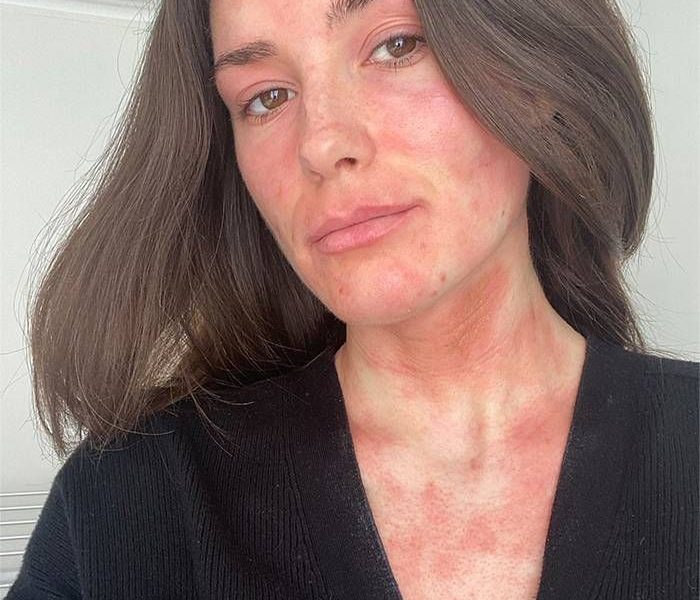 Blotchy, raised hives across a woman’s face, neck and chest