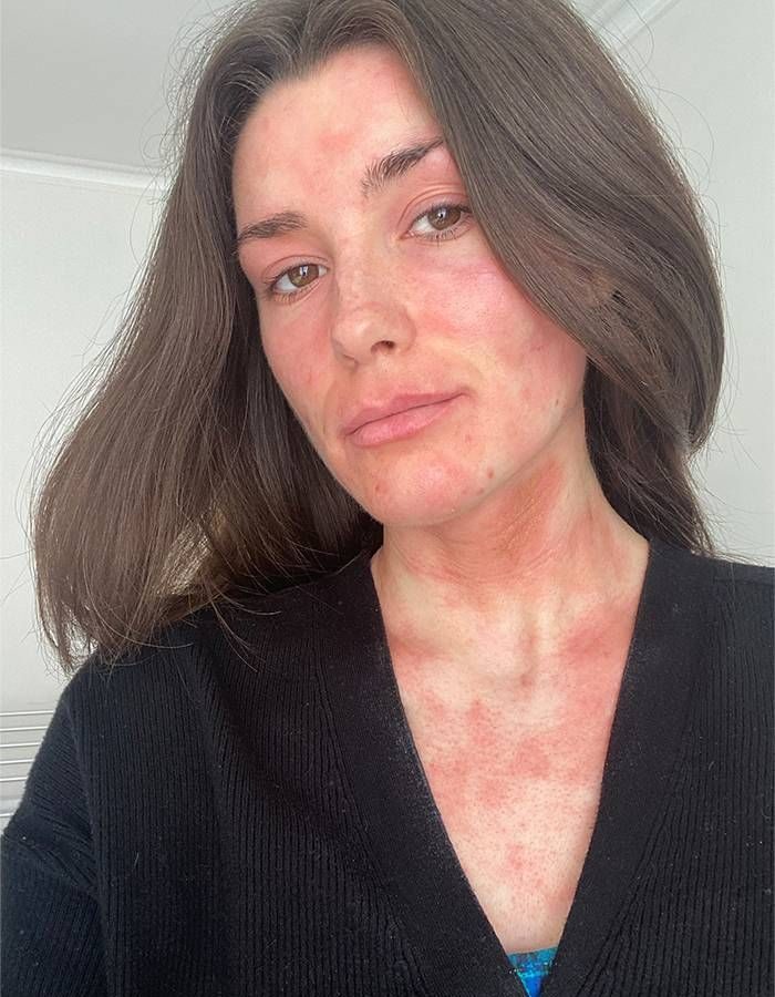 Blotchy, raised hives across a woman’s face, neck and chest