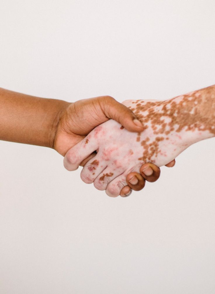 Two people shaking hands, one with vitiligo depigmentation